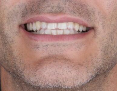 Antes
