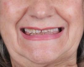 Antes
